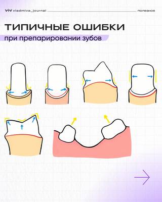 Компофикс имплантат: шесть ошибок обточки и слабый композит.